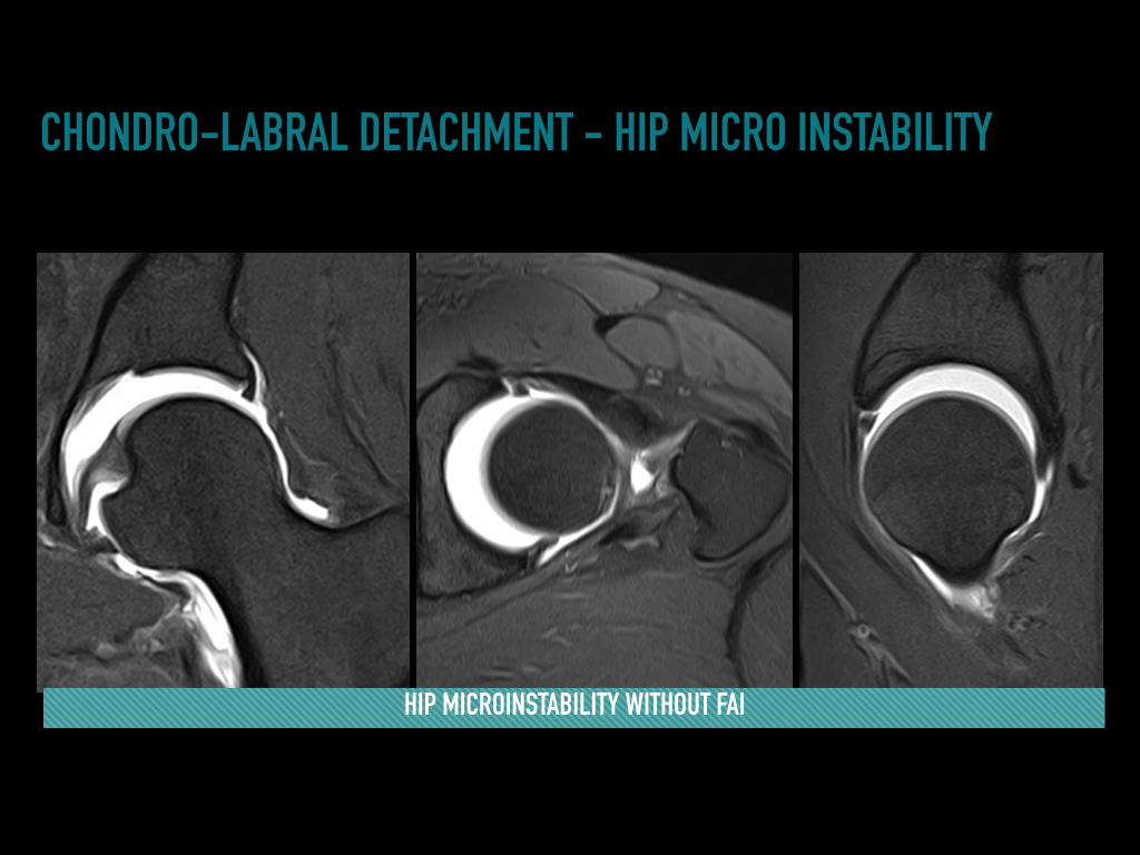 Figure 4 for case Sublabral sulcus